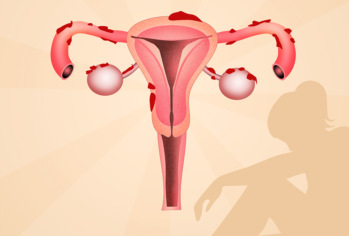 endometriosis