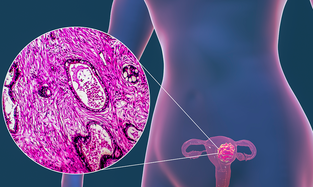 Uterine Cancer